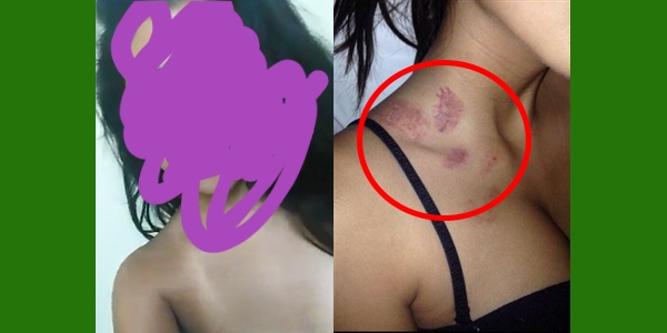 Mulher aparece toda chupada e diz a delegado ter sido atacada por Morcegão image for Mulher aparece toda chupada e diz a delegado ter sido atacada por Morcegão