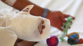 Quemados con polvora Brazo de personas quemado