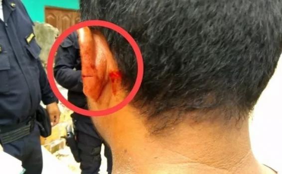 Herido en la oreja luego que unos sujetos le atacaran Cortan oreja a motocarrista que defendio a universitaria de delincuentes