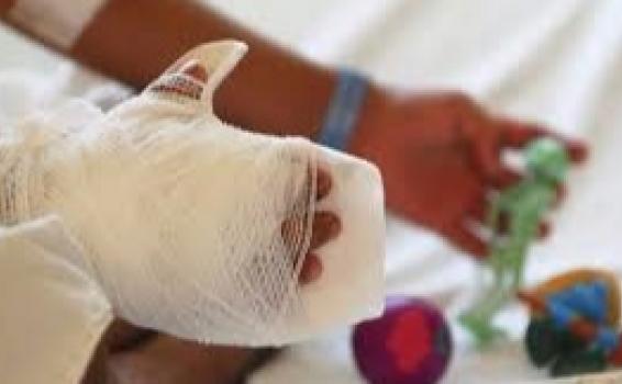 Quemados con polvora Brazo de personas quemado
